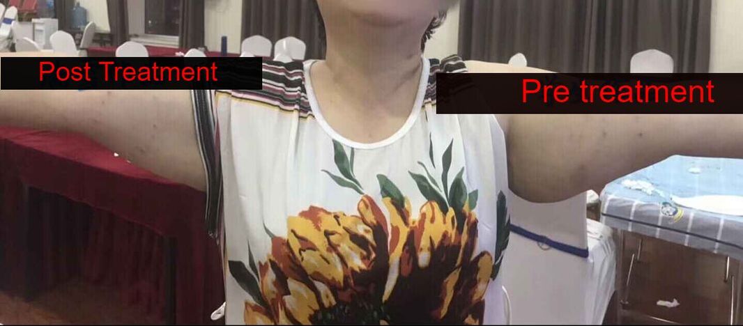 After full-face