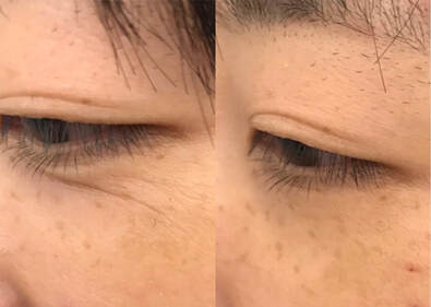 Eyes - before