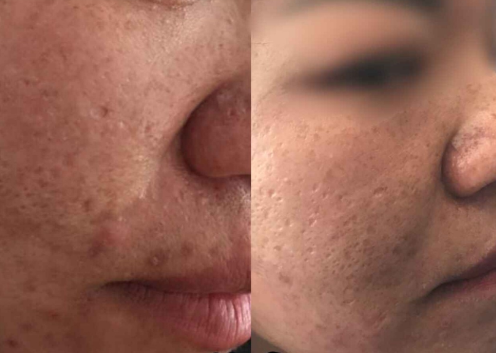 After full-face
